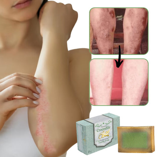 DermaCroc™ | Elimina Eczema y Psoriasis en 48 horas