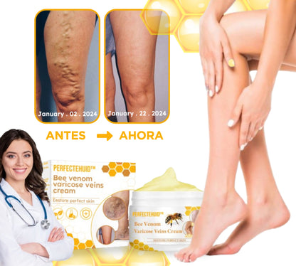 PerfectSkin™ | Elimina el 95% de las varices en tan solo 7 días