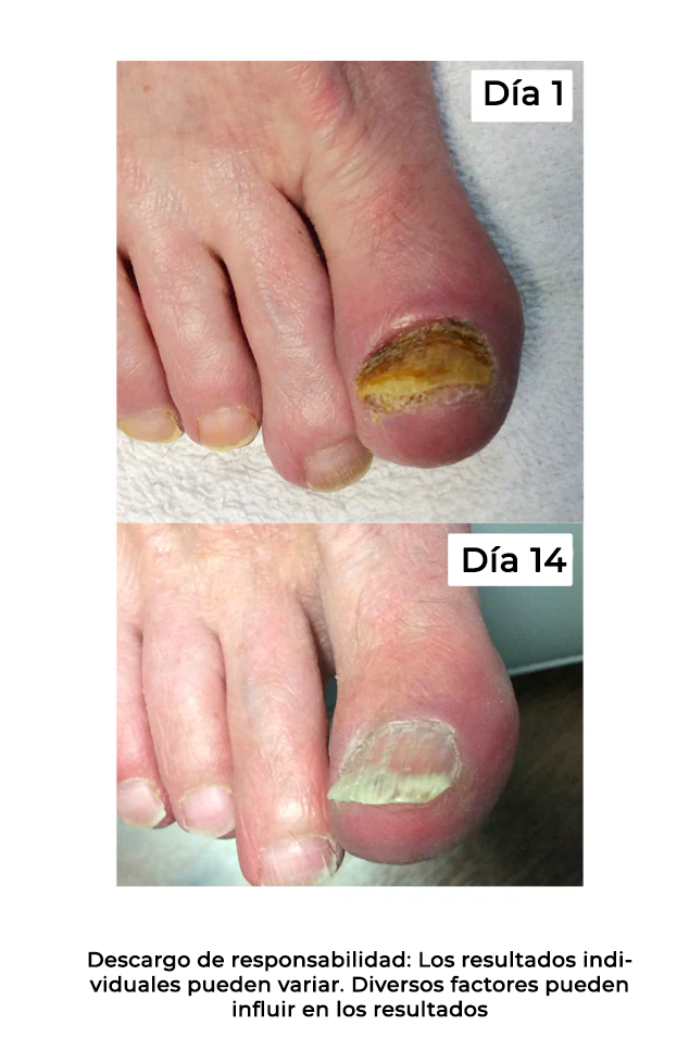 OedoNails™ Extracto para el cuidado de las uñas con veneno de abeja | ¡De suave a hermoso en sólo 14 días!