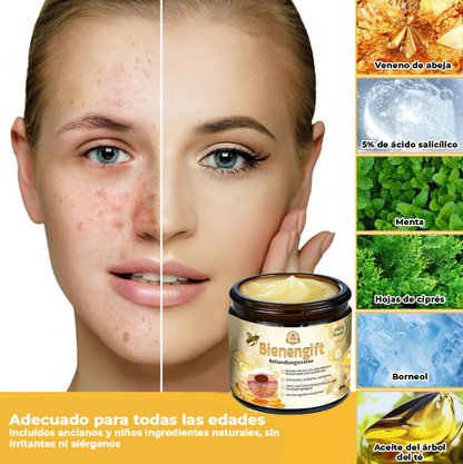 NaturBee™ | Elimina verrugas, granos y lunares en tan solo 7 días