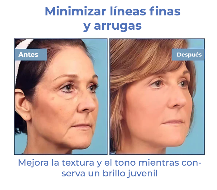 SkinLift™ | ¡Elimina tus arrugas y luce 10 años más joven en 5 días!