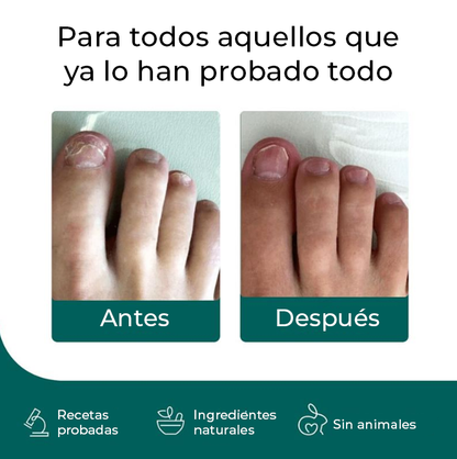 NailCare™ | Elimina los molestos hongos de las uñas en sólo 2 semanas