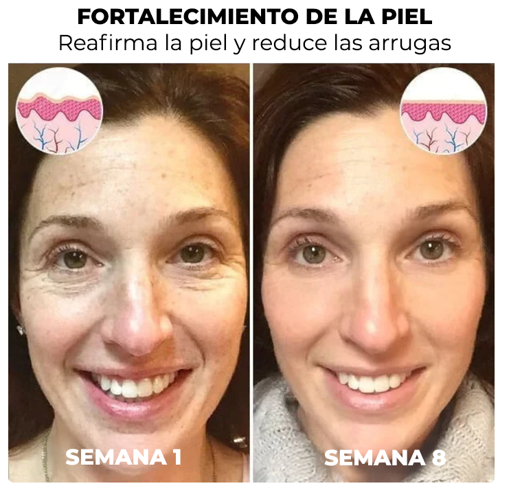 SkinLift™ | ¡Elimina tus arrugas y luce 10 años más joven en 5 días!