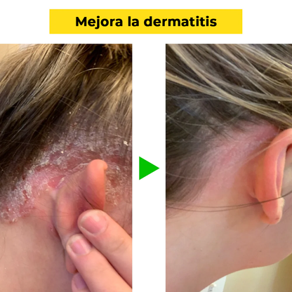 EastAsia™ | Trata el eczema y la psoriasis de forma natural y segura en solo 14 días