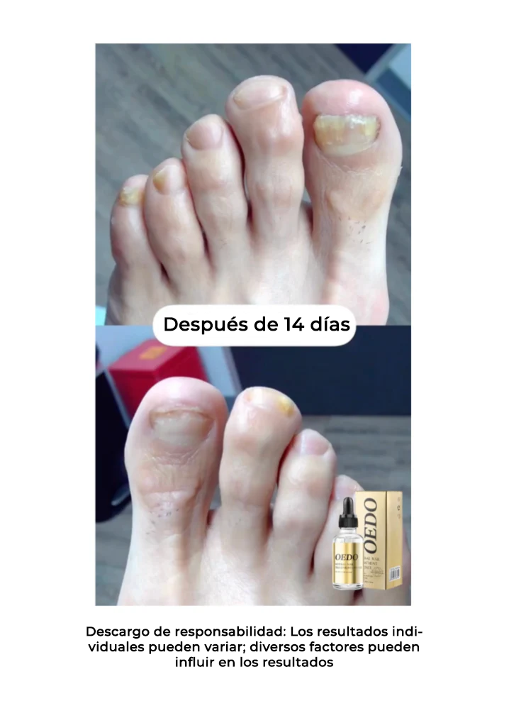 OedoNails™ Extracto para el cuidado de las uñas con veneno de abeja | ¡De suave a hermoso en sólo 14 días!