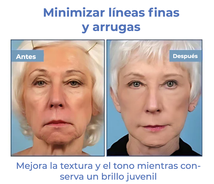 SkinLift™ | ¡Elimina tus arrugas y luce 10 años más joven en 5 días!