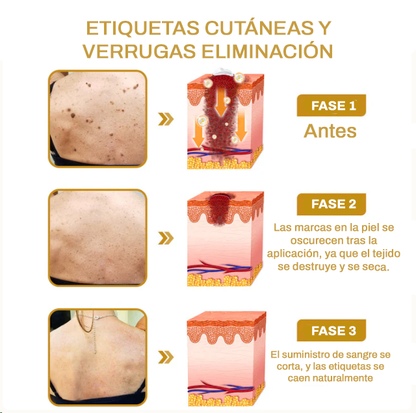 TakeTag™ | Elimina verrugas, granos y lunares en tan solo 7 días