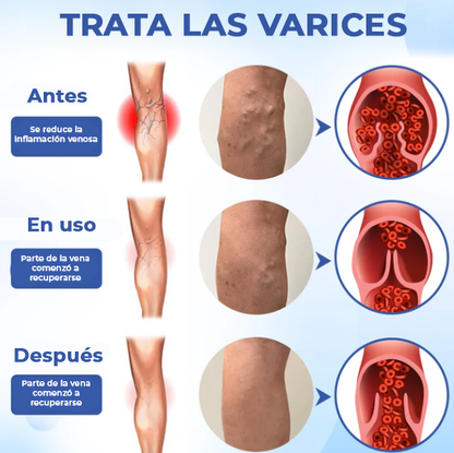 HealVein™ Spray para varices | El tratamiento Nº1 para las venas varicosas recomendado por cardiólogos