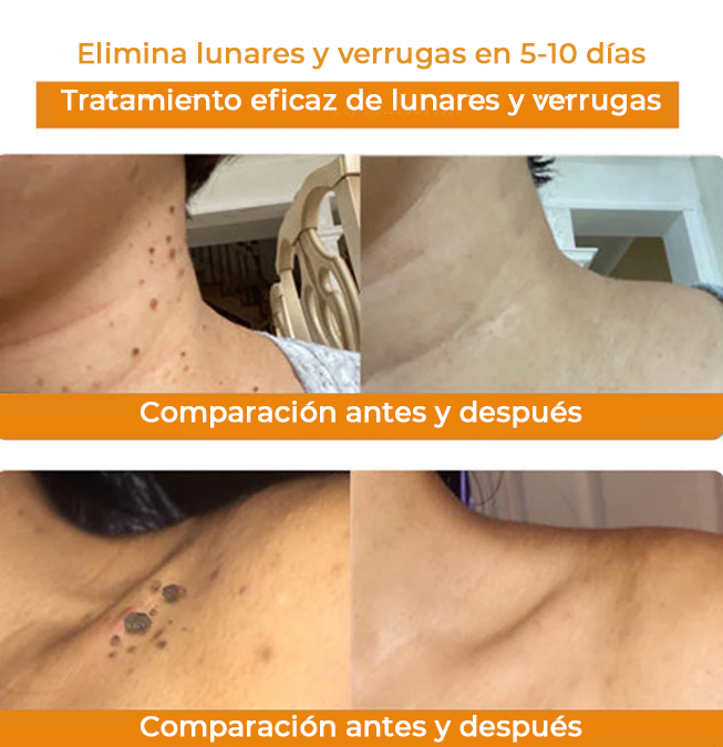 NaturBee™ | Elimina verrugas, granos y lunares en tan solo 7 días