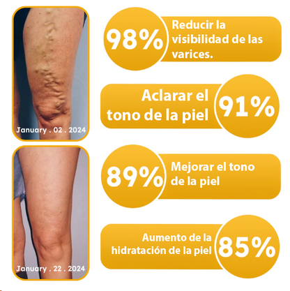 PerfectSkin™ | Elimina el 95% de las varices en tan solo 7 días