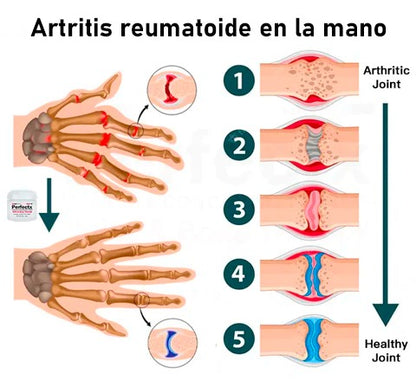 PerfectX™ | Elimina el 94% del dolor articular en tan solo 6 días