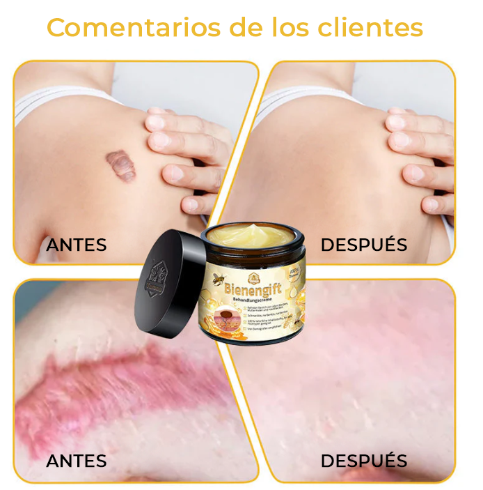 NaturBee™ | Elimina verrugas, granos y lunares en tan solo 7 días